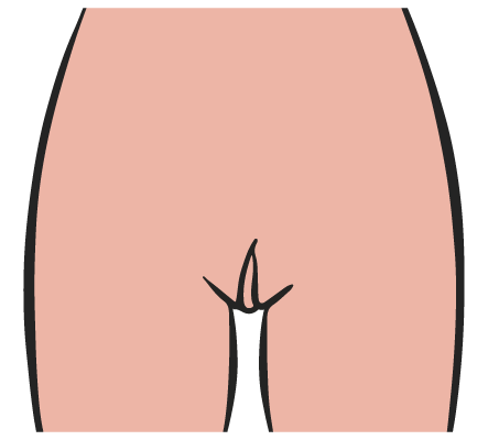vagina a tulipano